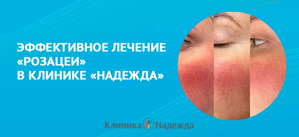 Розацеа. Основные факторы, способствующие развитию. Лечение.