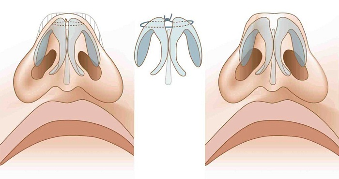 Септопластика: как вернуть носу способность дышать